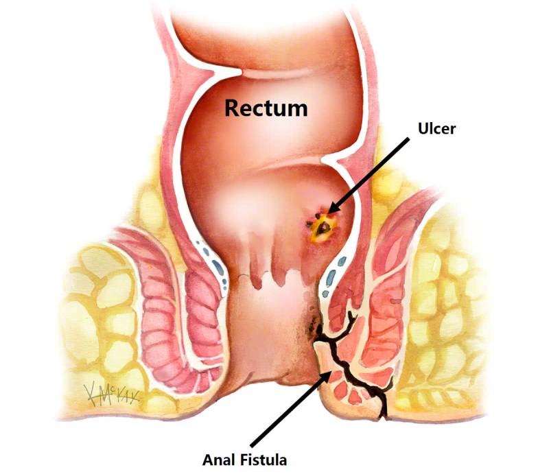 anal fistula (1)