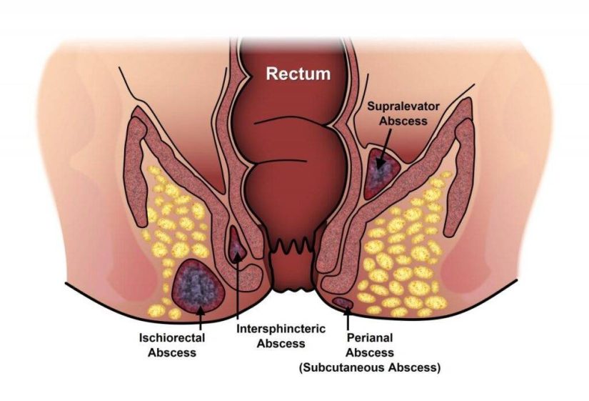 Signs-And-Symptoms-Of-Anal-Fistu
