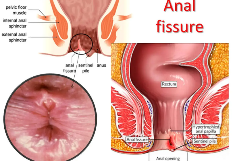en anal fissure